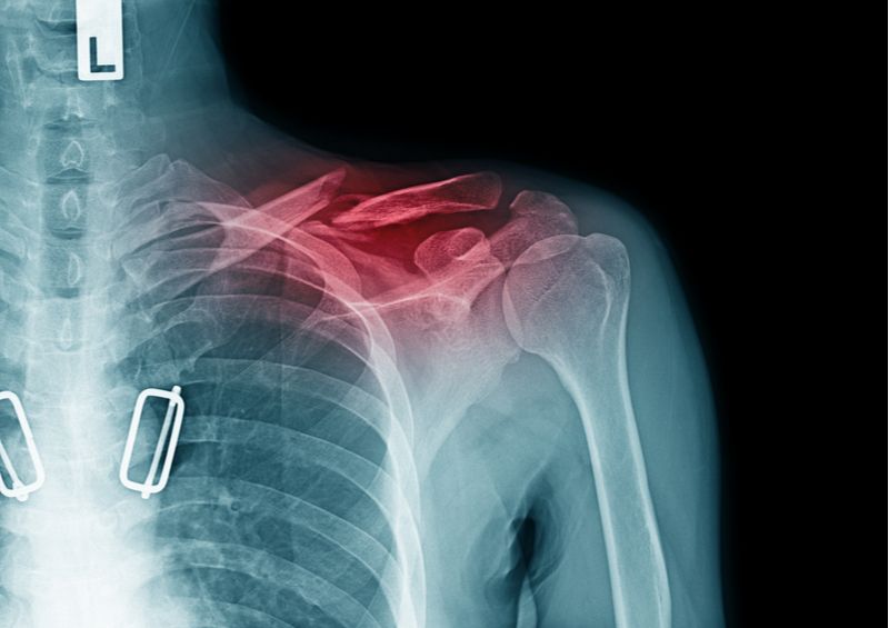 Repair Of Clavicle Fractures